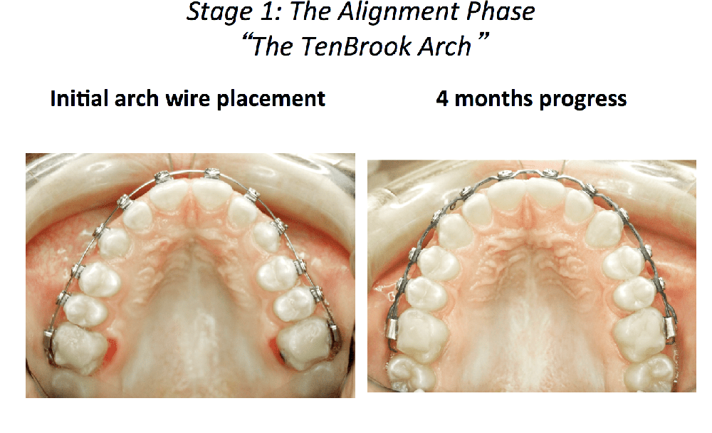 What Moves Teeth the Fastest?